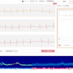 Personalising IBD management with EMR data